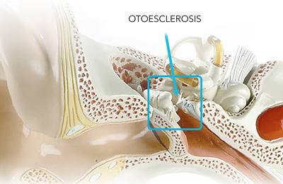 Otosclerosis - Otorrino - Doctor Ernesto Ried Goycoolea