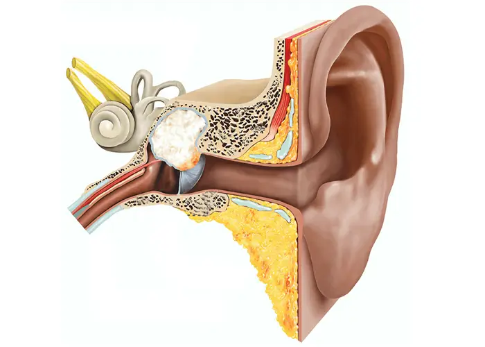 Colesteatoma