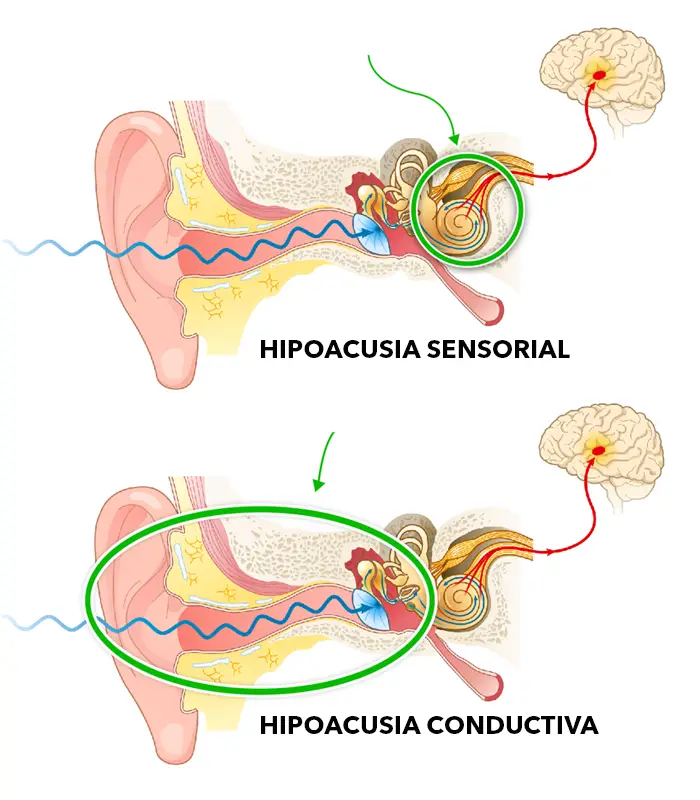 procedimiento-hipoacusia