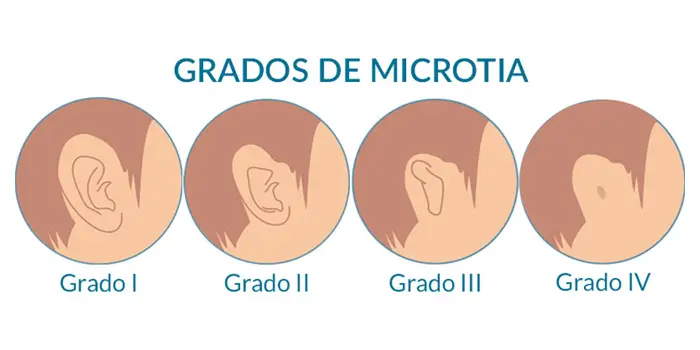 procedimiento-microtia