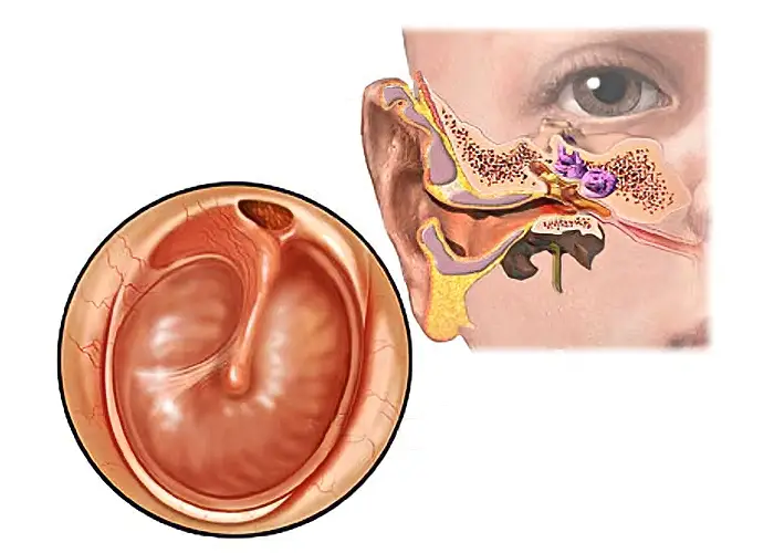 procedimiento-otitis-media otitis crónica