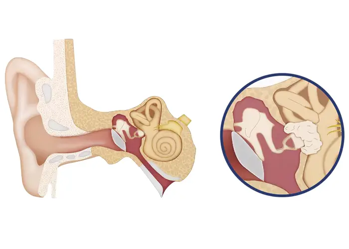 procedimiento-otosclerosis otoesclerosis