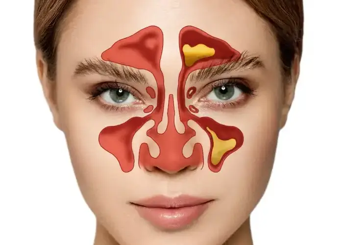 Sinusitis