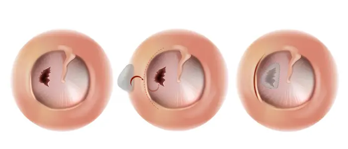 procedimiento-timpanoplastia timpanoplastía