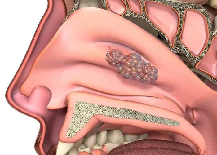 tumor nasal