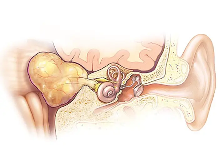 procedimiento-tumor-oido tumor de oído
